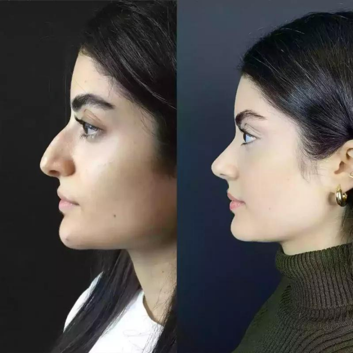 Rhinoplasty in Dubai: Embracing Confidence and Self-Expression