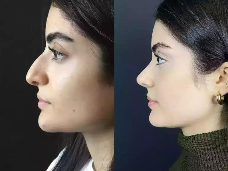 Rhinoplasty in Dubai: Embracing Confidence and Self-Expression